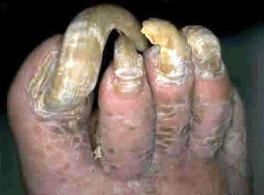 why does toe nail fungus aching